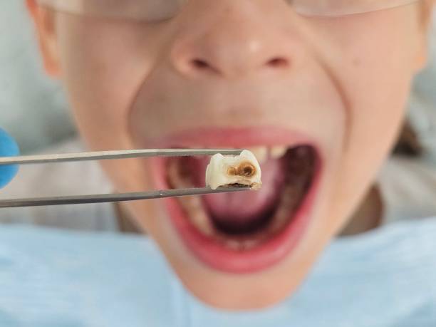 Best Knocked-Out Tooth (Avulsed Tooth) Treatment in Mary Esther, FL